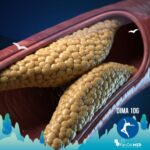 Dieta chetogenica e colesterolo, una fotografia iperrealistica e dettagliata di un'arteria umana che mostra un significativo accumulo di placca di colesterolo giallastra all'interno, con una prospettiva angolata che ne enfatizza l'ostruzione. L'illuminazione drammatica crea contrasti e mette in risalto la texture della placca, mentre il tessuto arterioso circostante appare sano.